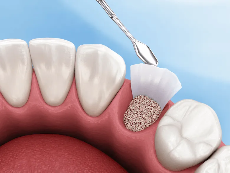 Bone Grafting Near Me In Jenkintown, PA - Best Dental Clinic For All Dental Treatment Near Me Bone Grafting Near Me In Jenkintown, PA - Best Dental Clinic For All Dental Treatment Near Me