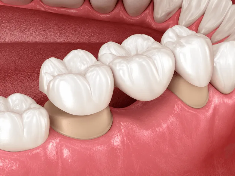 Crowns & Bridges Near Me In Jenkintown, PA - Best Dental Clinic For All Dental Treatment Near Me Crowns & Bridges Near Me In Jenkintown, PA - Best Dental Clinic For All Dental Treatment Near Me