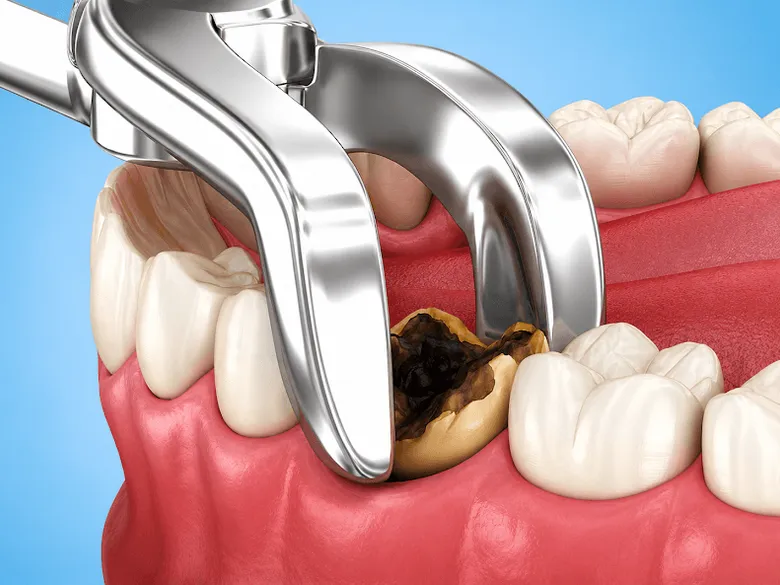 Dental Extraction Near Me In Jenkintown, PA - Best Dental Clinic For All Dental Treatment Near Me Dental Extraction Near Me In Jenkintown, PA - Best Dental Clinic For All Dental Treatment Near Me