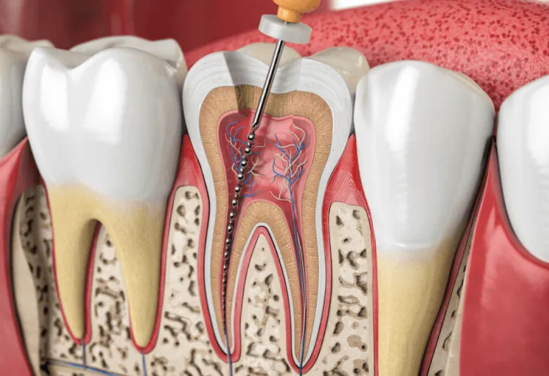 Root Canal Treatment Near Me In Jenkintown, PA - Best Dental Clinic For All Dental Treatment Near Me Root Canal Treatment Near Me In Jenkintown, PA - Best Dental Clinic For All Dental Treatment Near Me