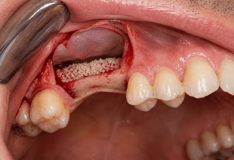 Sinus Lift Near Me In Jenkintown, PA - Best Dental Clinic For All Dental Treatment Near Me Sinus Lift Near Me In Jenkintown, PA - Best Dental Clinic For All Dental Treatment Near Me