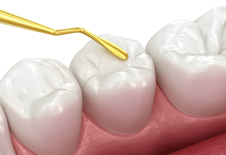Tooth-Colored Fillings Near Me In Jenkintown, PA - Best Dental Clinic For All Dental Treatment Near Me Tooth-Colored Fillings Near Me In Jenkintown, PA - Best Dental Clinic For All Dental Treatment Near Me
