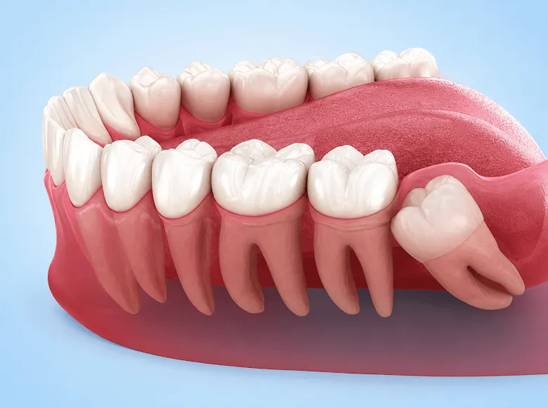 Wisdom Teeth Removal Near Me In Jenkintown, PA - Best Dental Clinic For All Dental Treatment Near Me Wisdom Teeth Removal Near Me In Jenkintown, PA - Best Dental Clinic For All Dental Treatment Near Me