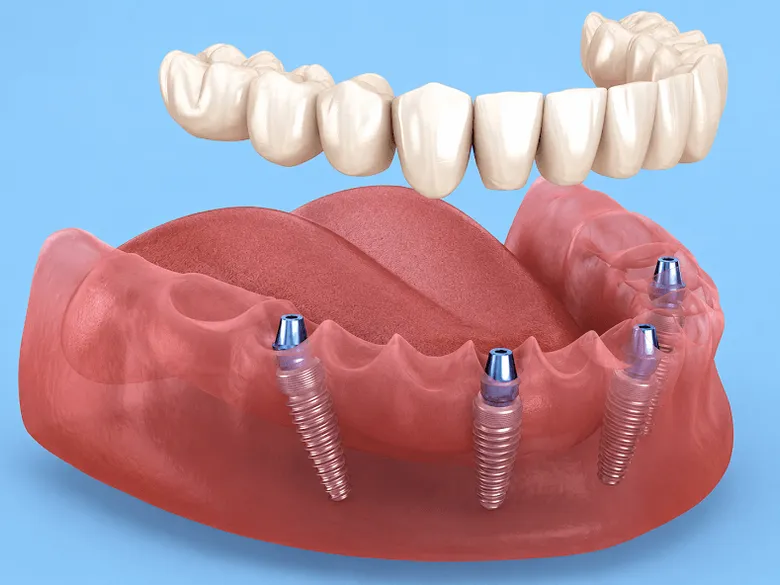 All-on-X Near Me In Jenkintown, PA - Best Dental Clinic For All Dental Treatment Near Me All-on-X Near Me In Jenkintown, PA - Best Dental Clinic For All Dental Treatment Near Me