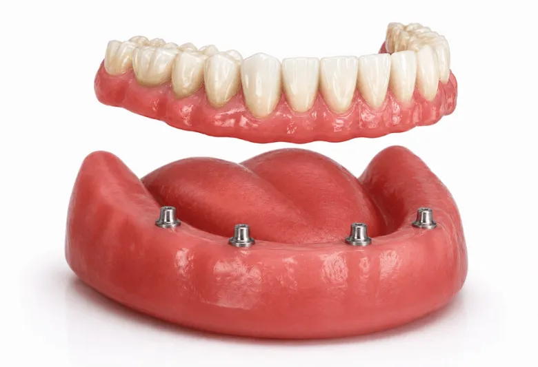 Overdentures Near Me In Jenkintown, PA - Best Dental Clinic For All Dental Treatment Near Me Overdentures Near Me In Jenkintown, PA - Best Dental Clinic For All Dental Treatment Near Me